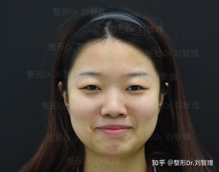 割双眼皮真的有必要吗,有必要割双眼皮吗