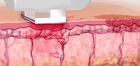 血丝多怎么办,血丝红是怎么回事