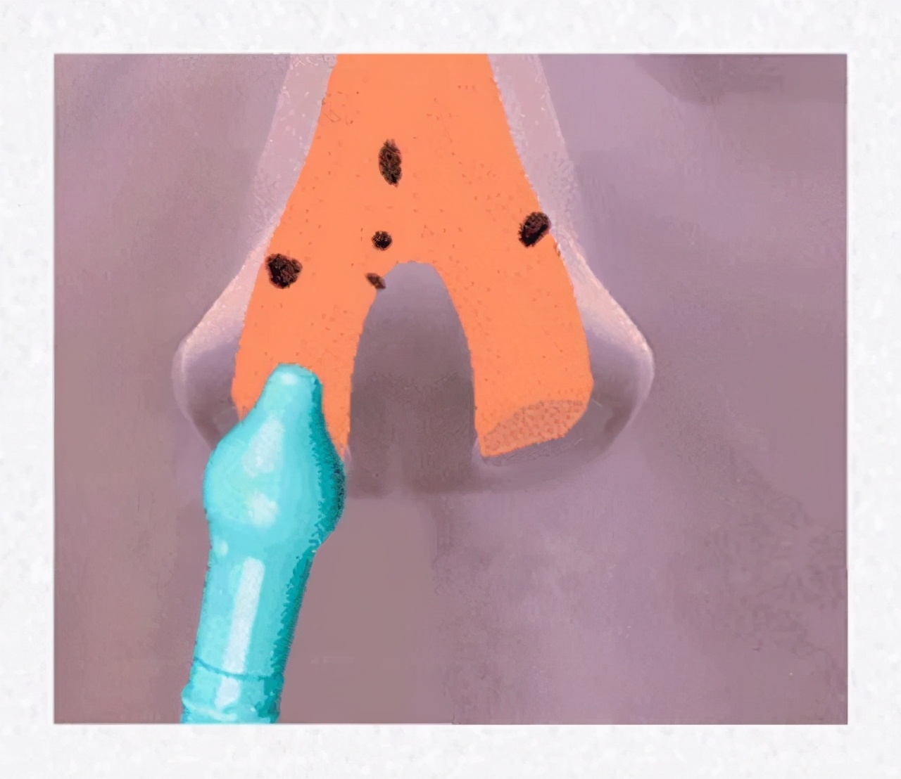 宝宝鼻塞流鼻涕不吃药怎么治,宝宝流鼻涕鼻塞不吃药怎么治疗