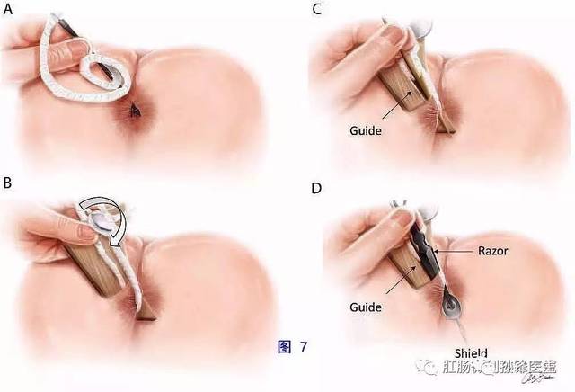 形成瘘管就是肛瘘吗,怀疑自己是肛瘘