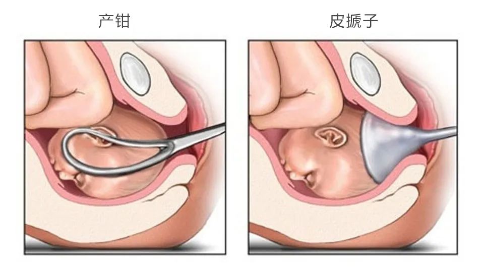 儿啊，你是用「皮搋子」吸出来的