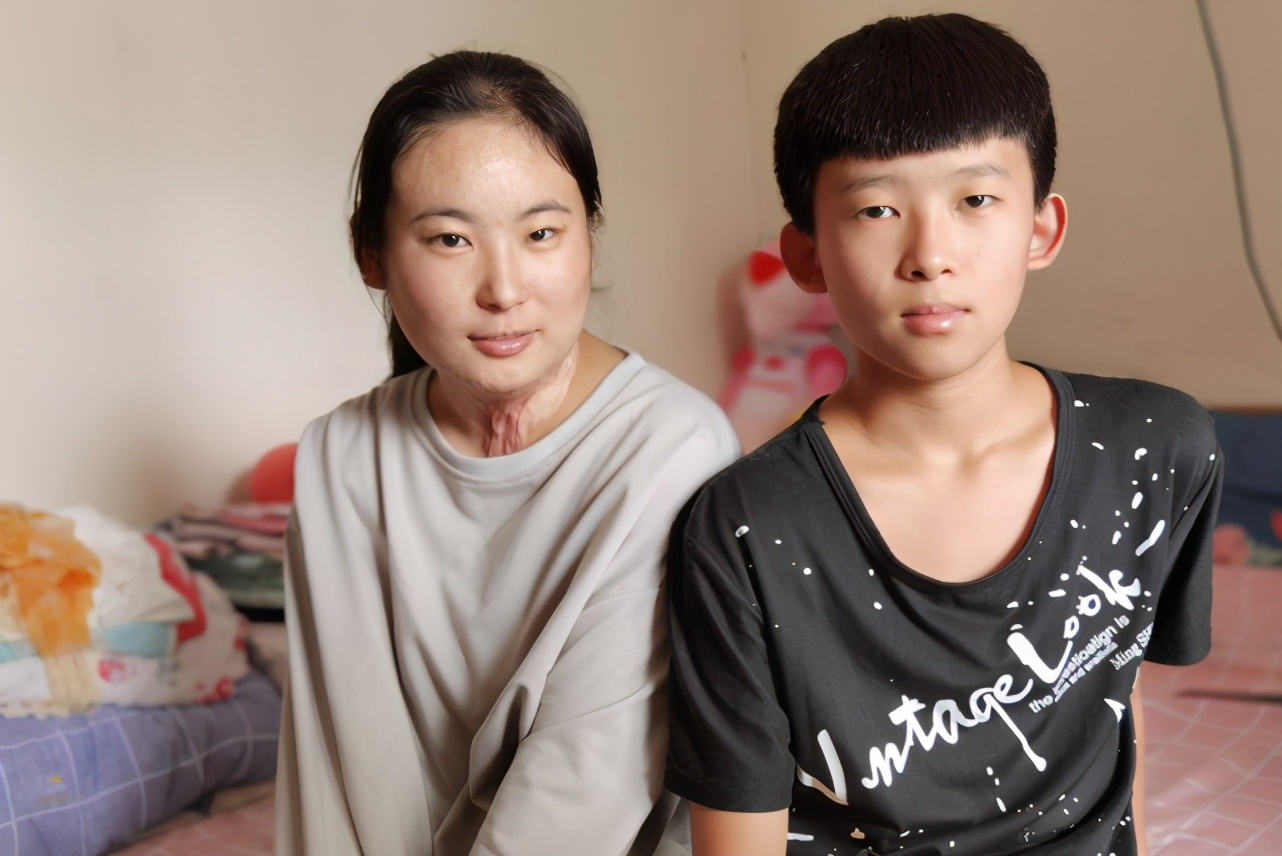 16岁女孩救弟弟严重烧伤,11岁少年救妹妹被火烧伤