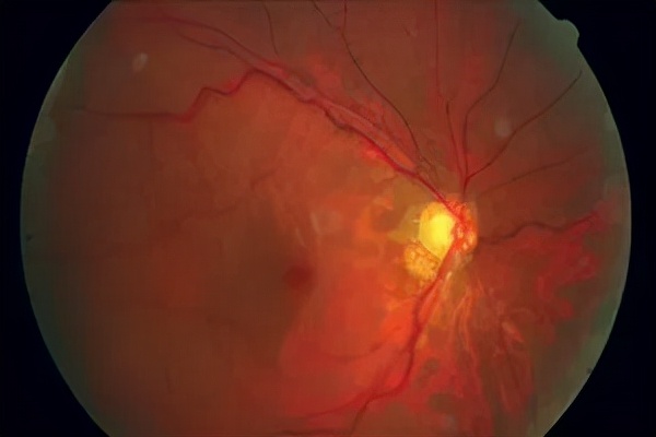 遗传高度近视会失明吗,高度近视会遗传是什么原理