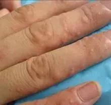 警惕！身上出现这种小水泡，千万别挠！现在看还不晚