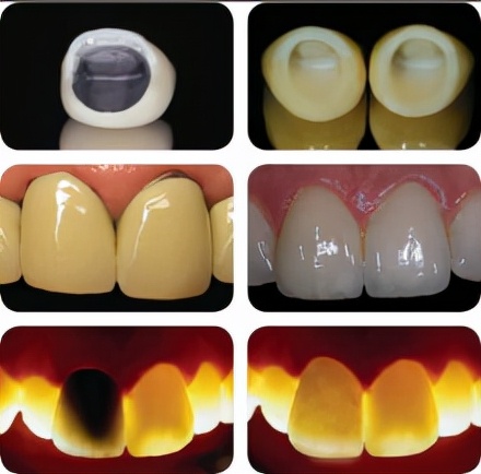 国内的种植牙究竟如何,种植牙好吗医生详细告诉你优缺点