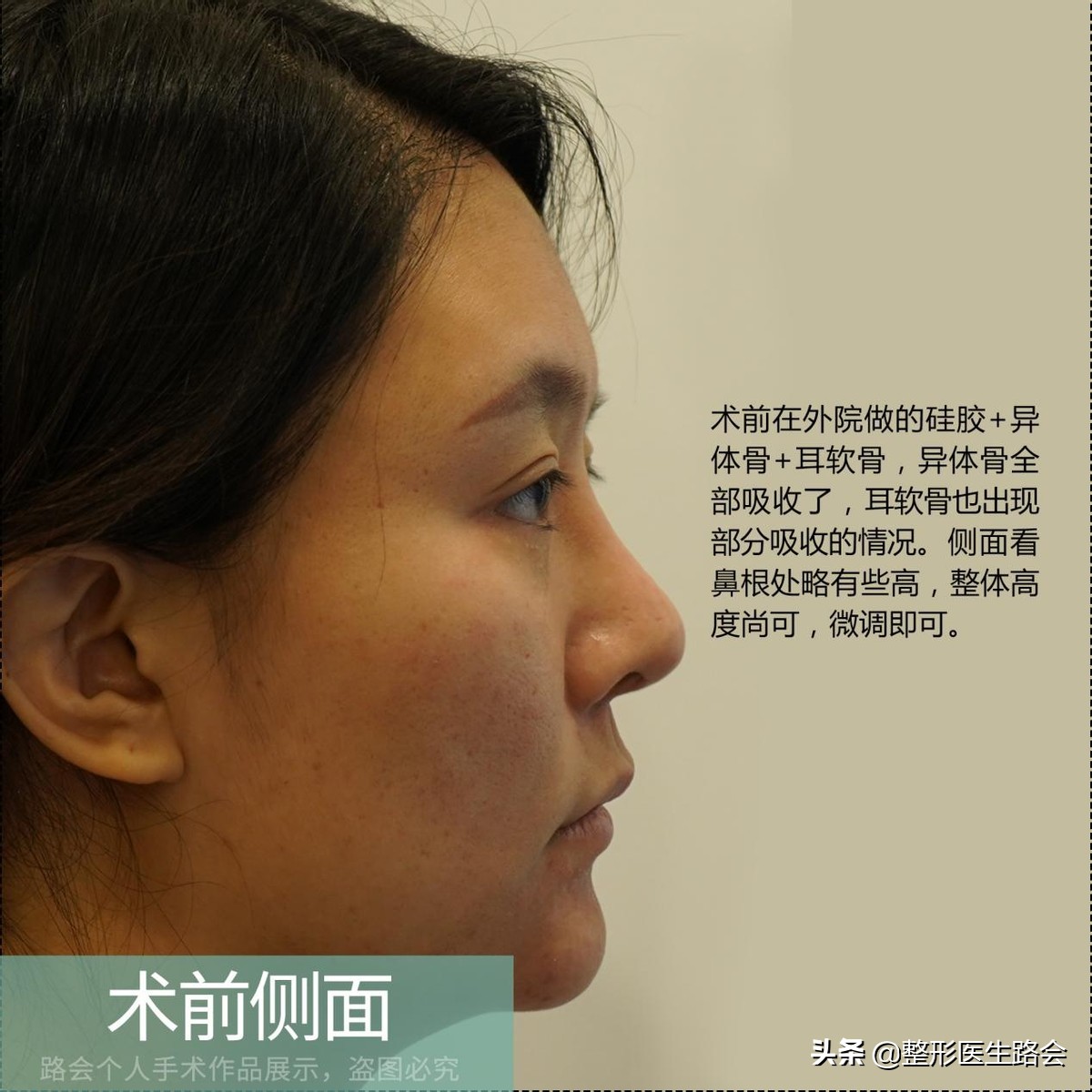 一定得惊艳才好看吗,膨体鼻整形全过程