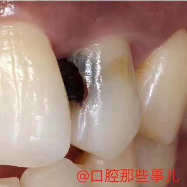 想要补个牙反而被磨了个大洞,大牙牙洞很大很深能补吗