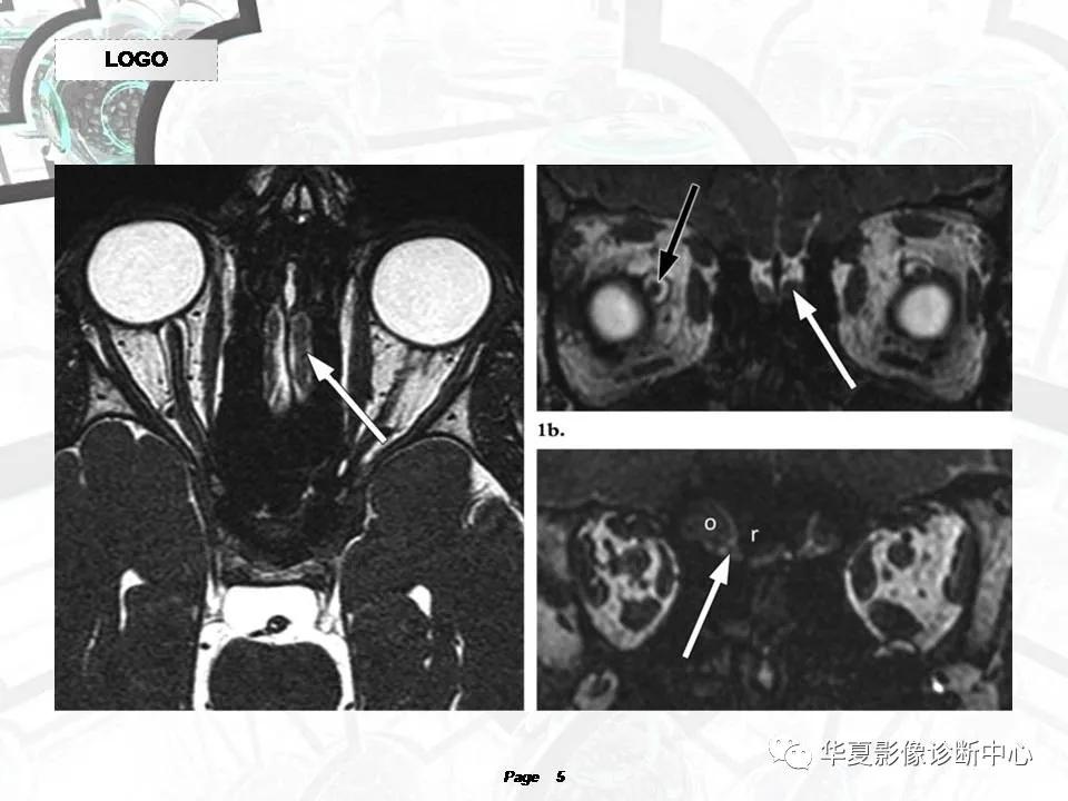 磁共振颅神经扫描是定位在哪,颅神经图谱