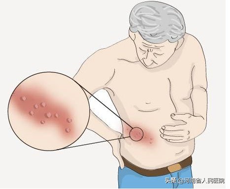 关于带状疱疹的7个错误认识,带状疱疹的十大误区