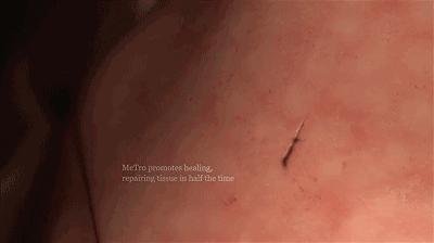 新疗法和一般疗法哪个更好,普通放射疗法