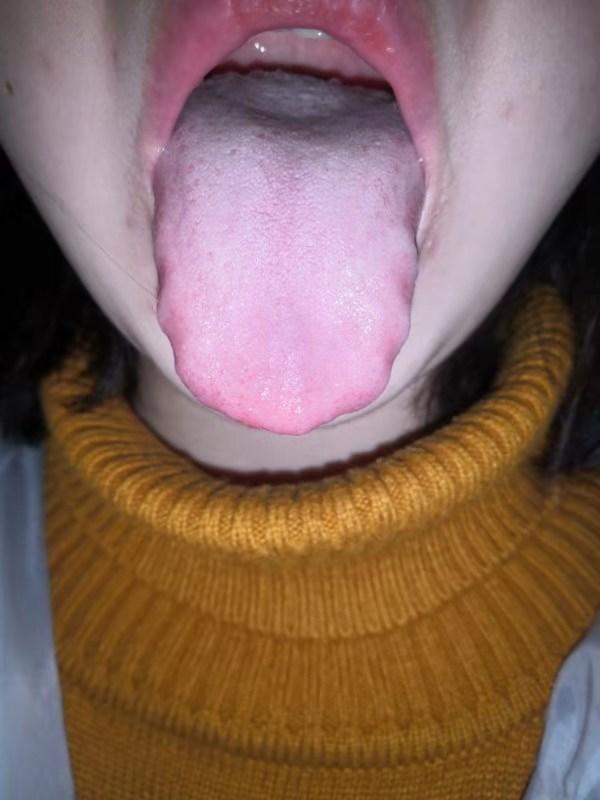 中药治疗腮腺炎、低热患者病案1例（1周）