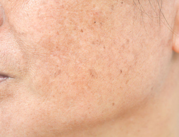 有效收缩毛孔告别毛孔恐惧症,收缩毛孔粗大什么效果最好