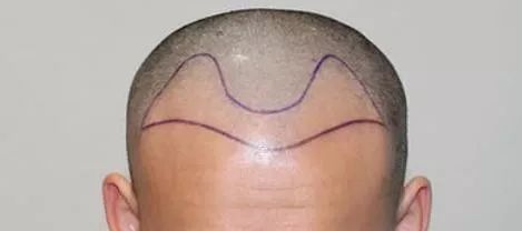 m型脱发1-7级程度图片,m型脱发后长出绒毛能恢复吗