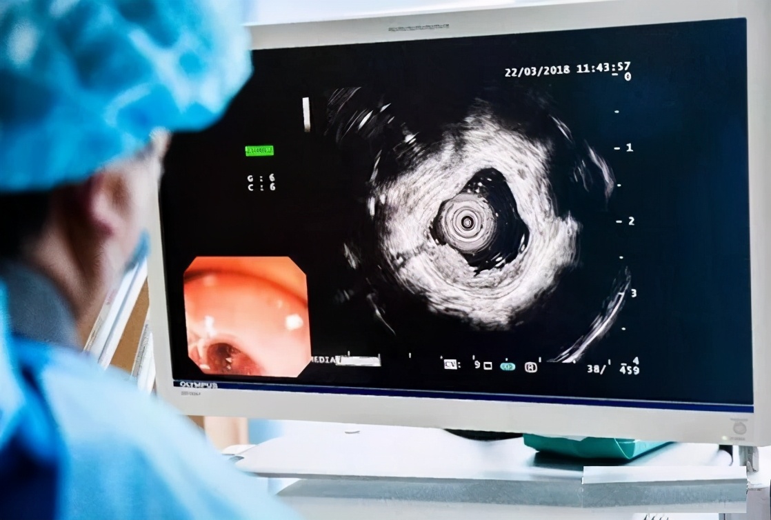 镜界“二郎神”——超声内镜知识科普