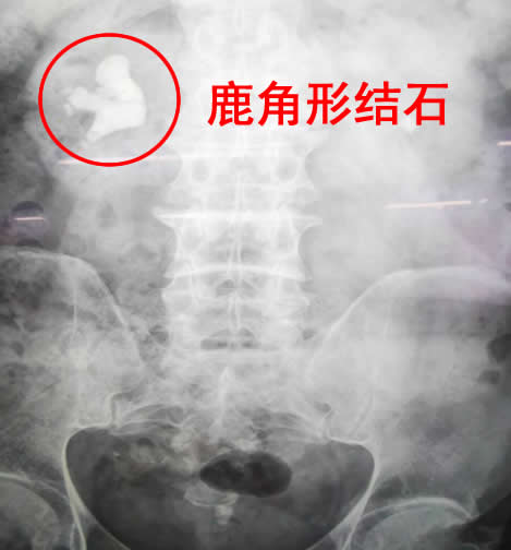 94岁老人肾脏内长鹿角哈医大一院多学科协作挽救患者生命