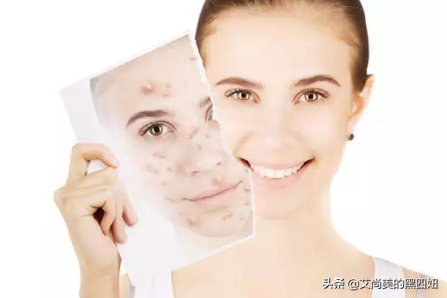 嘴巴周围老是反复长痘已经半年了,47岁嘴周围反复长痘什么原因