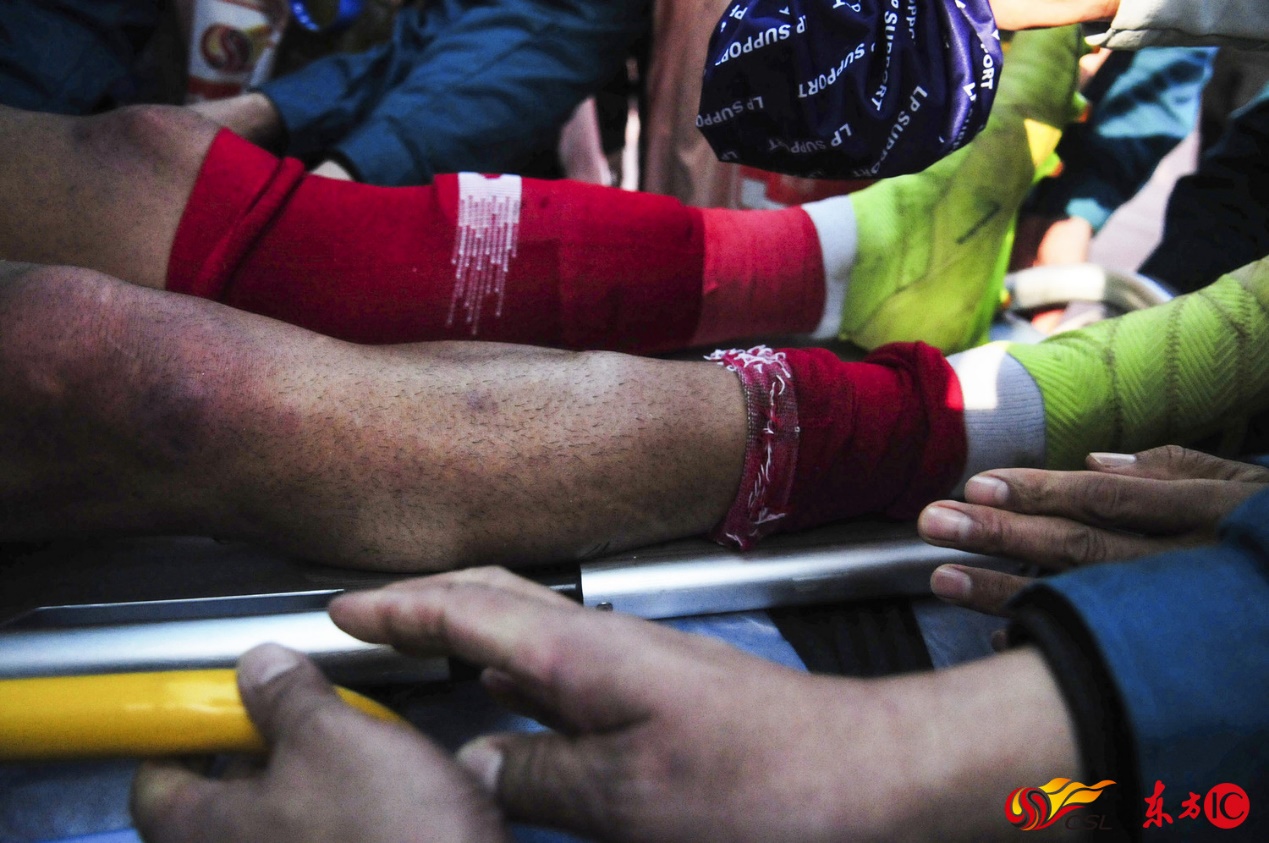 伤情证明上多处骨折,小腿胫骨开放性骨折伤情