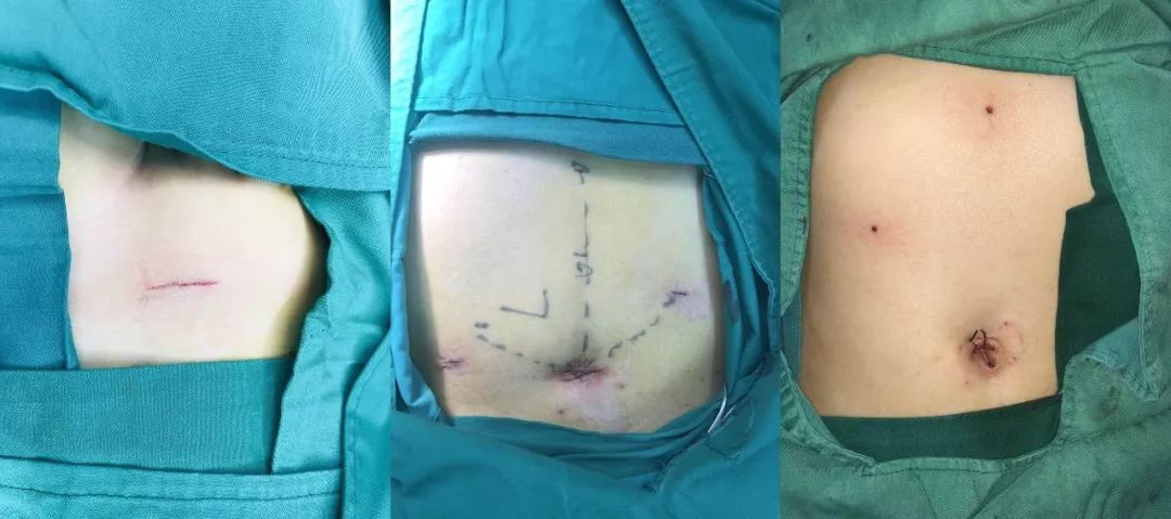 儿童医院疝气手术,聊城人民医院疝气手术多少钱