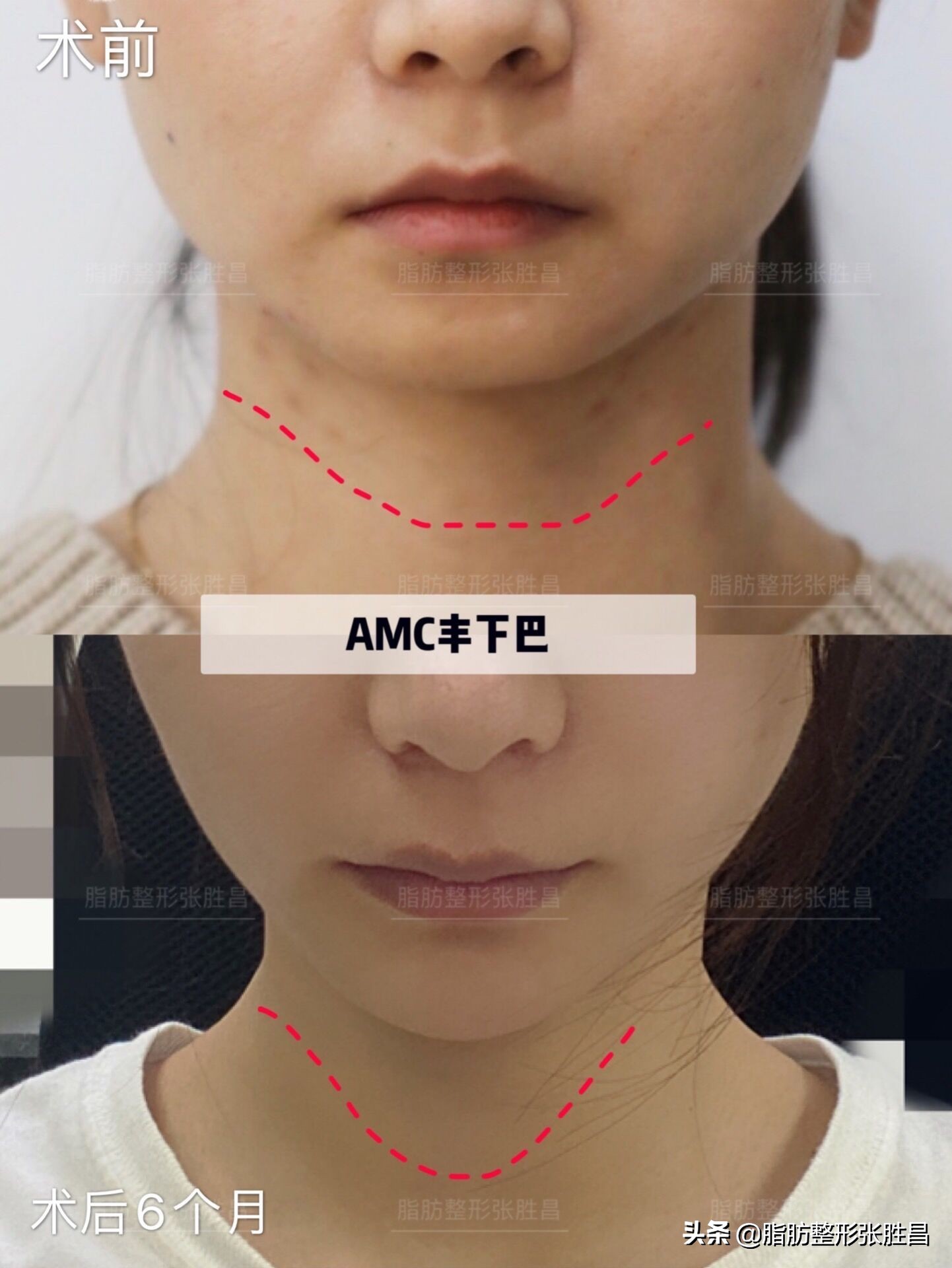 下巴缩短整容女,下巴短小北京