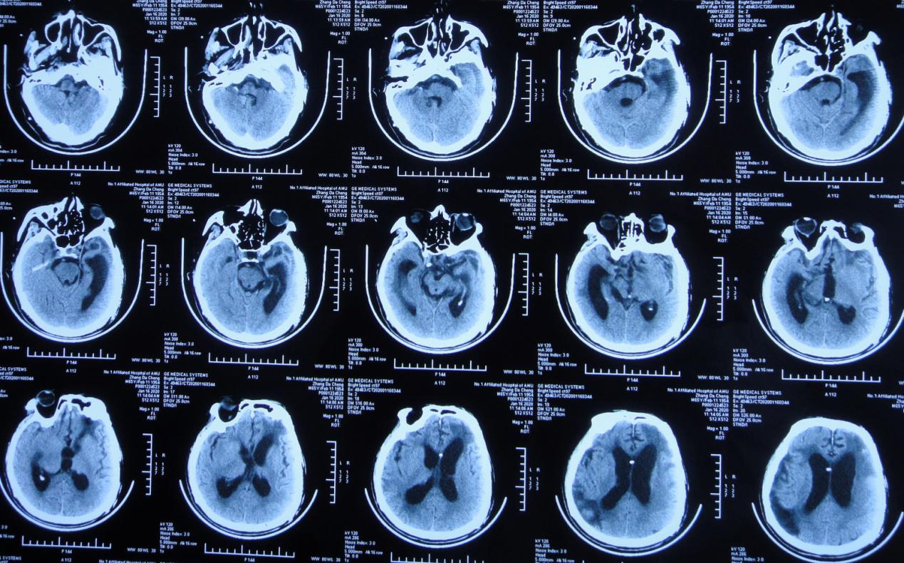 颅脑外伤术后脑积水,脑外伤脑积水颅骨缺失