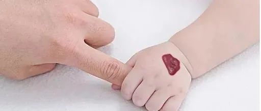 宝宝有一块红胎记是血管瘤吗,新生儿红胎记正常吗