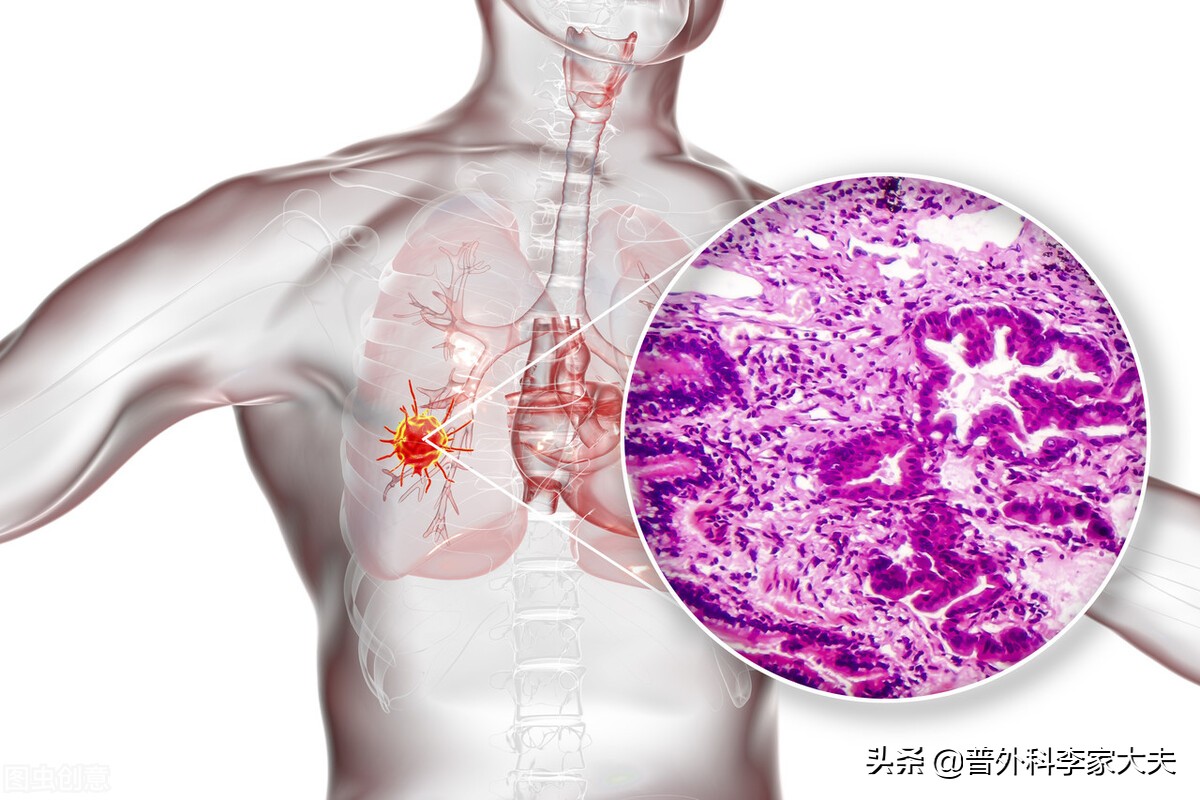 肺原位癌手术后要注意什么,肺癌原位癌手术切除后为何还复发
