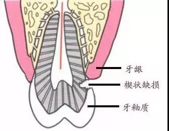 楔状缺损坑,较深的楔状缺损