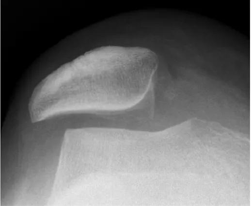 膝盖髌骨上下楼梯疼痛怎么办,髌骨外倾可以矫正过来吗