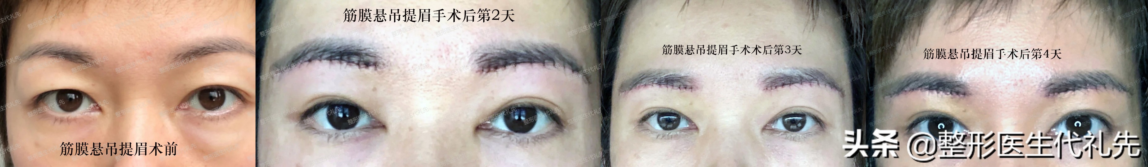 面部松弛提拉最好的方法,面部松弛下垂最好的提拉手术