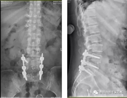 腰椎脓肿会发烧吗,腰间盘突出引起下肢疼痛发烧