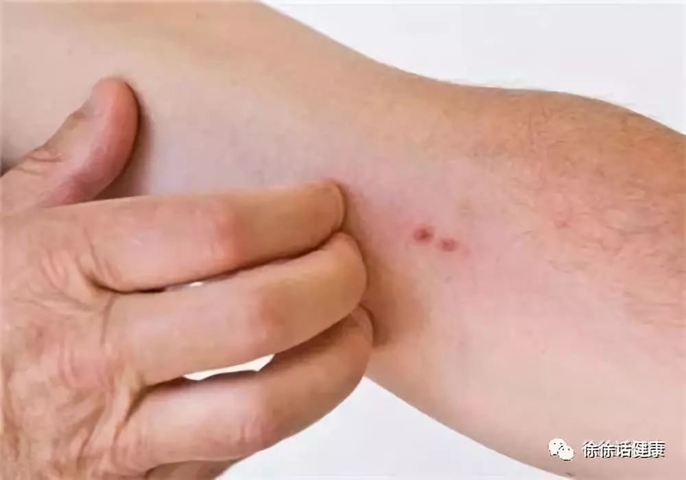 血虚湿蕴型皮肤瘙痒症,皮肤瘙痒是身体缺啥吗