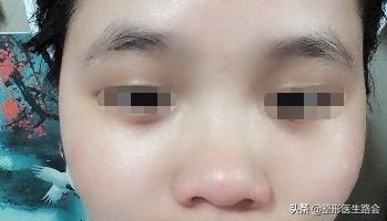 鼻子的鼻梁塌下来了怎么提上来,塌鼻子如何让鼻梁变高变挺