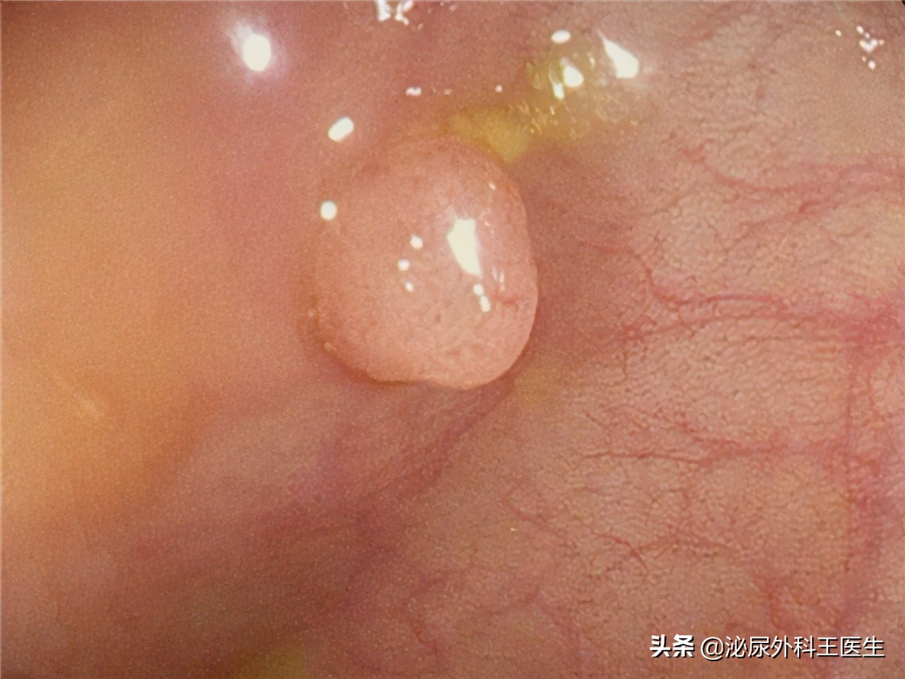 男子每天大便两三次结果是肠癌,大便带血的肠癌怎么判断早期晚期