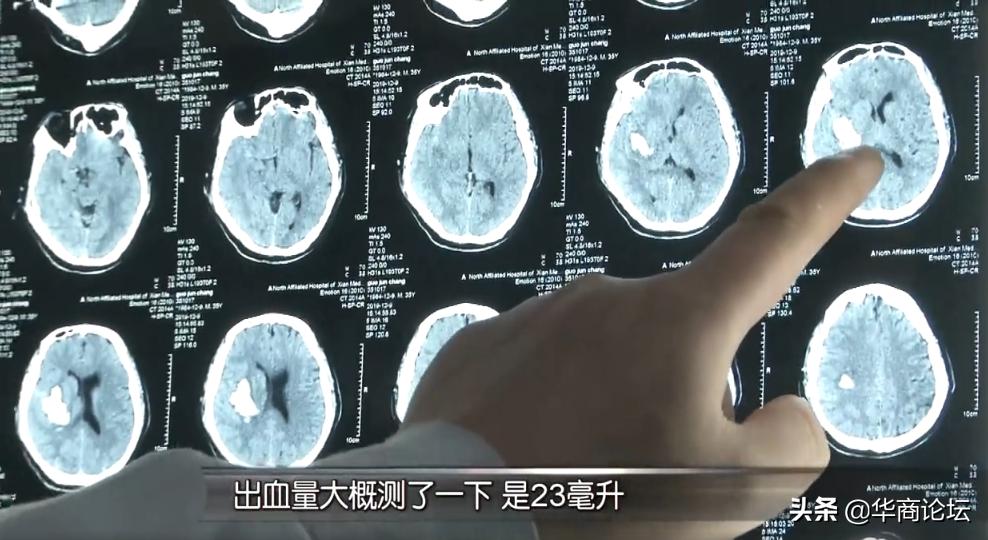 每日最陕西｜西安一男子颈部被医生抽出百余毫升腐臭脓液，致病原因竟如此常见！你平时注意过吗？