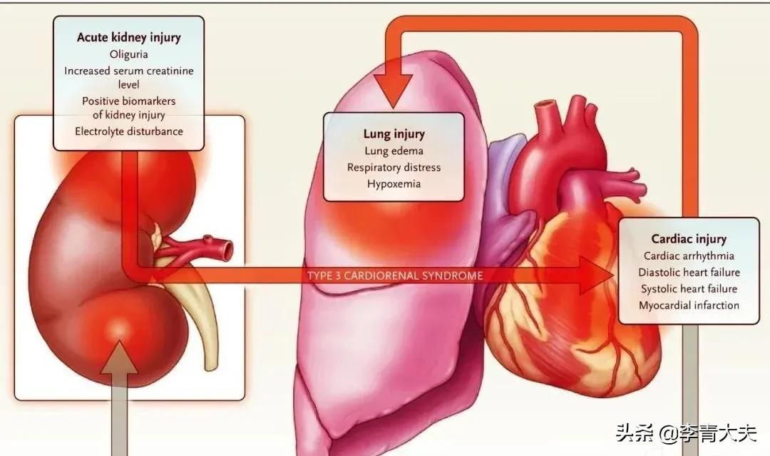 心肾综合征的诊治,心血管疾病与肾脏疾病哪个更严重