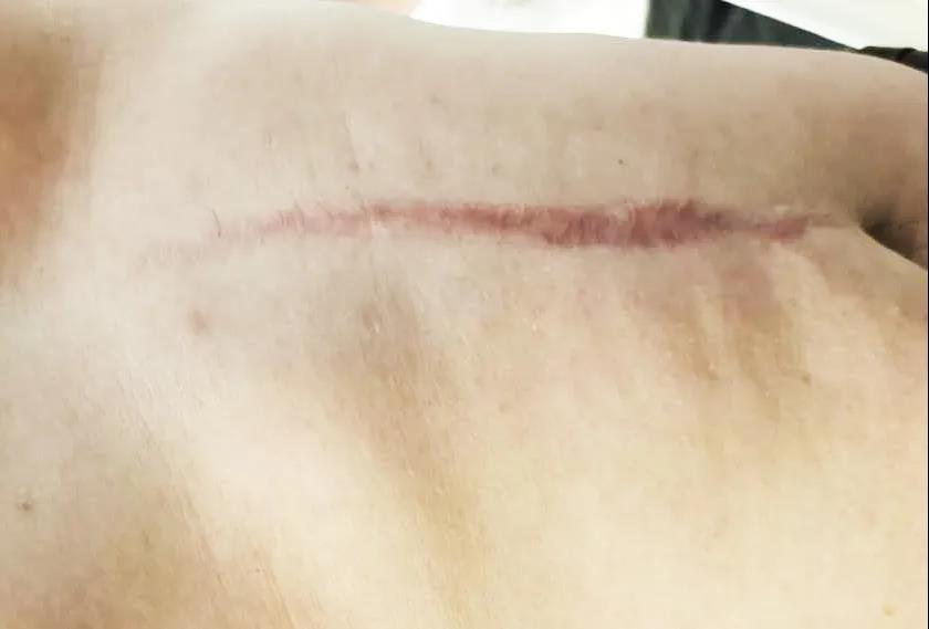 “我打死你！”10.5厘米长的钉子射穿面部后，他竟毅然朝嫌疑人扑去