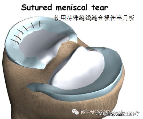 半月板损伤通常是单膝还是双膝,你知道半月板是什么吗