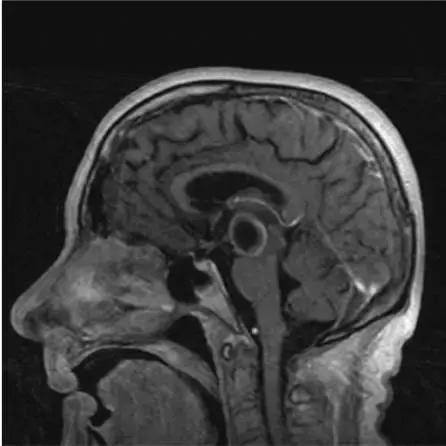 各种囊肿的症状,颅内囊肿18-19mm严重吗