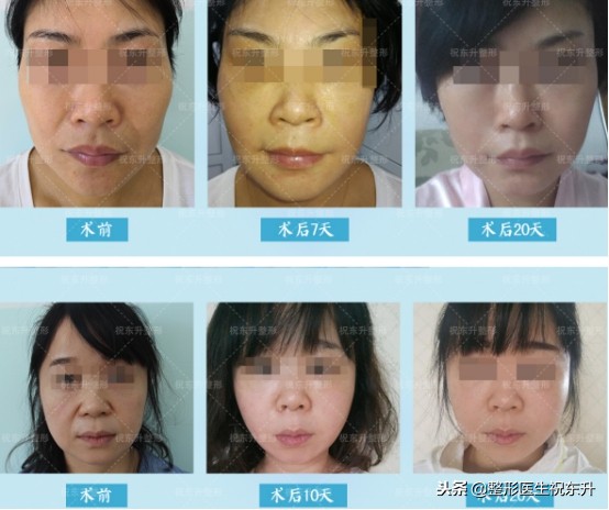 法令纹显老10岁三种方法帮助改善,脸上有法令纹最好解决的办法