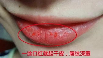 改善干燥起皮护唇液,三个护唇小妙招应对嘴唇干裂起皮