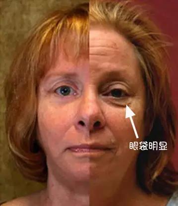 北大整形教授张宗学,全国有名的眼袋整形专家