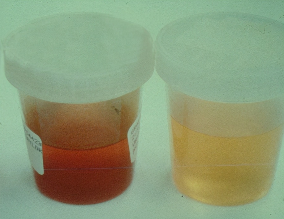 过敏性紫癜性肾炎,过敏性紫癜性肾炎的临床表现