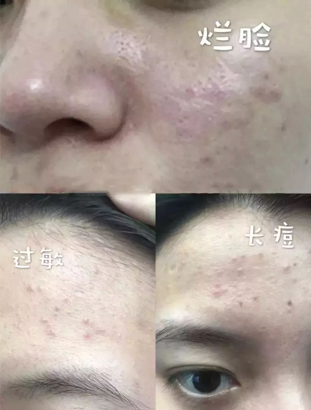 男生螨虫脸特征,螨虫脸的特征