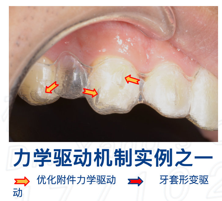 正畸医生杨磊,北大口腔医院修复科杨磊