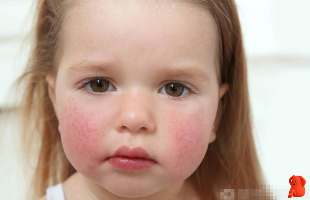 夏季宝宝脸蛋红并粗糙怎么样缓解,宝宝皮肤薄怎么改善