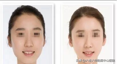 爱美人士打瘦脸针,爱美除皱针效果怎么样