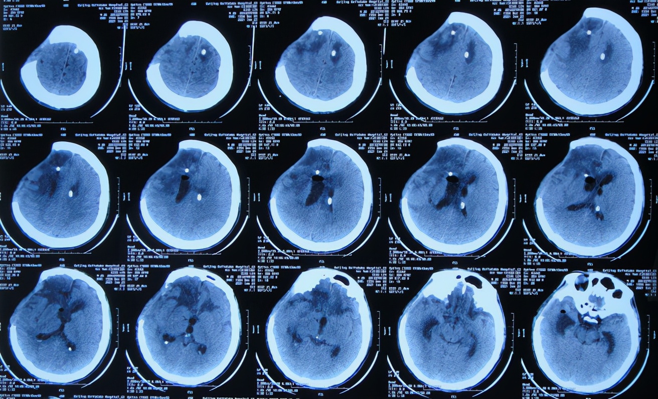 开颅手术后颅内细菌感染图片,外伤开颅手术后脑积液能恢复吗