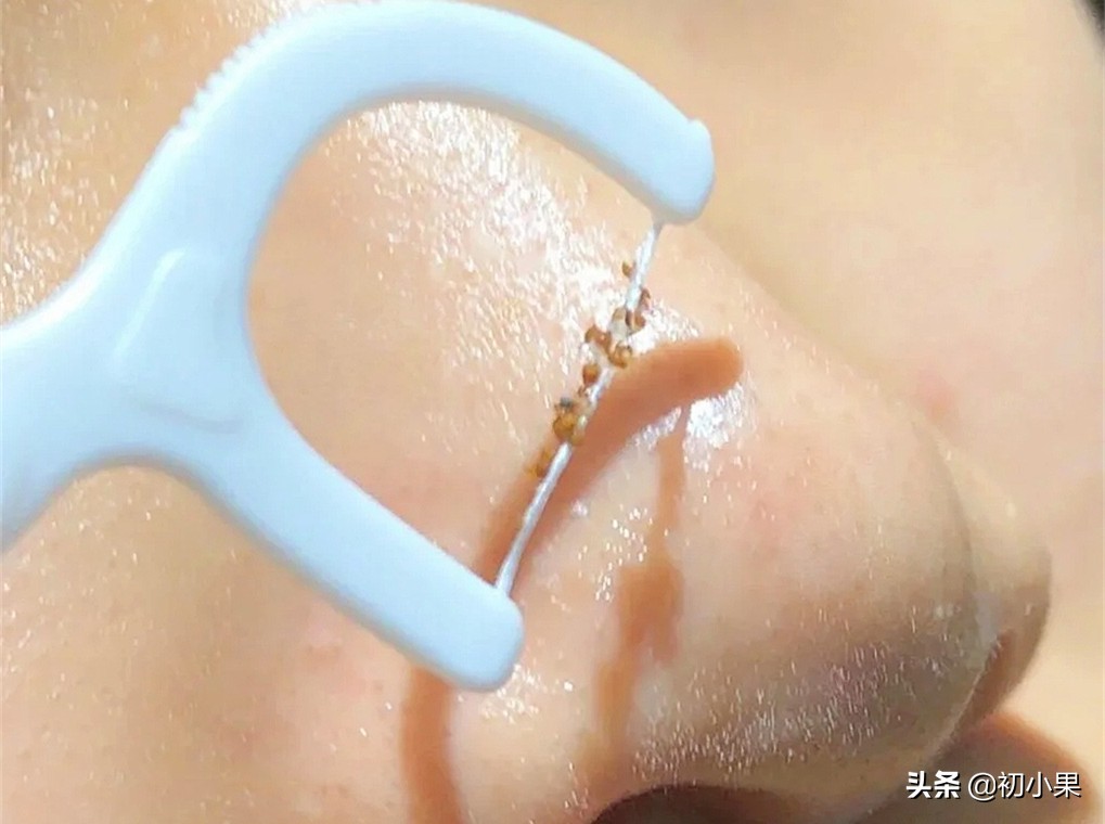 鼻子上的黑头怎么去除,鼻子上的黑头怎么去除儿童