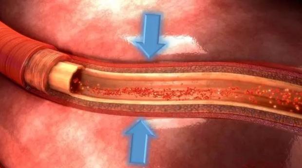 心脏有心肌桥是怎么回事啊,心脏有压榨感是心肌桥的事吗