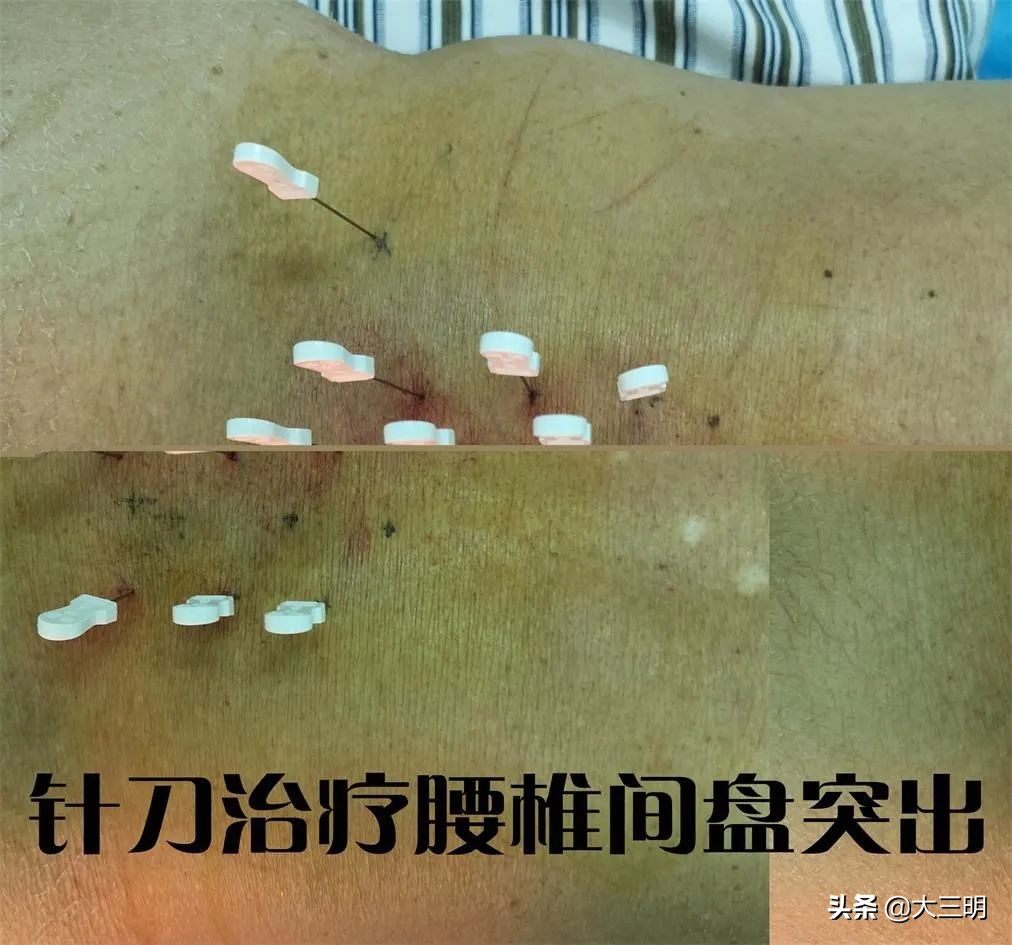 顽固性网球肘的敲打治疗,网球肘针刀效果怎么样